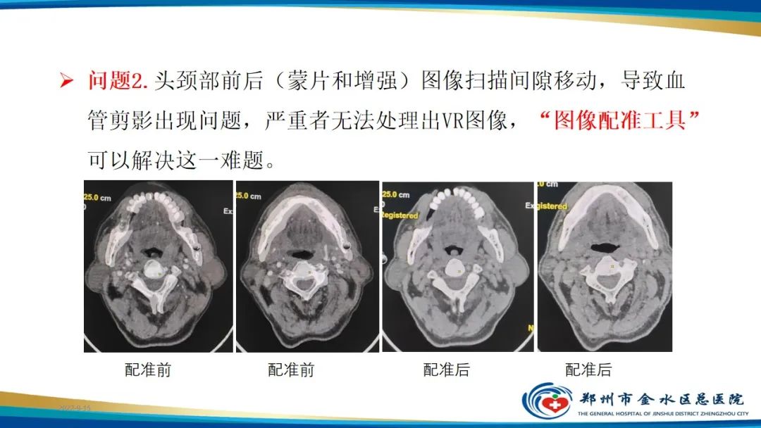 影像PPT - 【PPT】冠脉头颈一站式CTA联合扫描技术-29