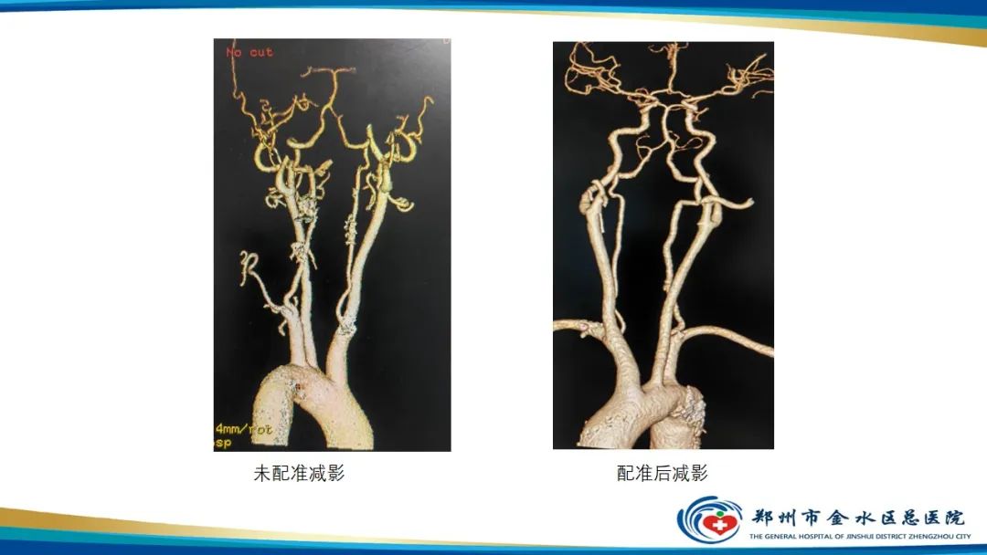 影像PPT - 【PPT】冠脉头颈一站式CTA联合扫描技术-30