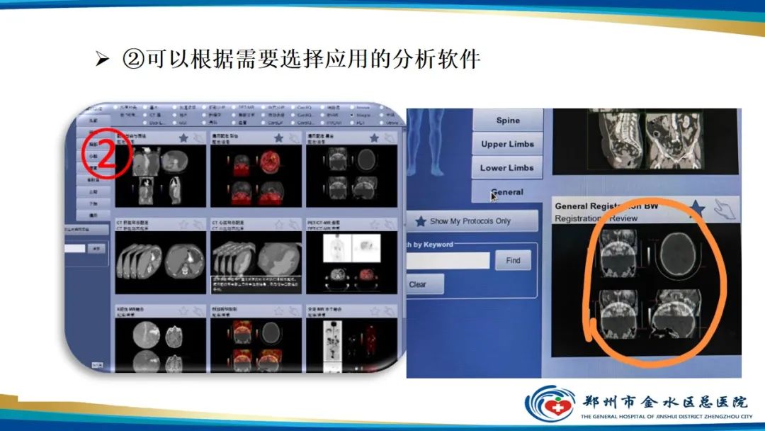 影像PPT - 【PPT】冠脉头颈一站式CTA联合扫描技术-32