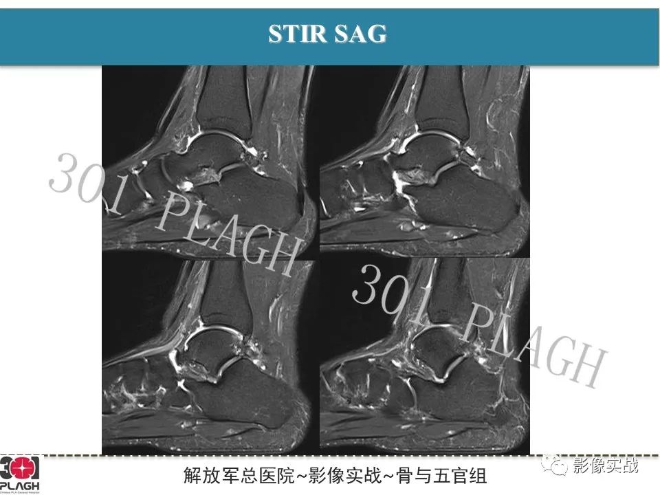 影像PPT - 【病例】后踝撞击综合征1例MR影像-4