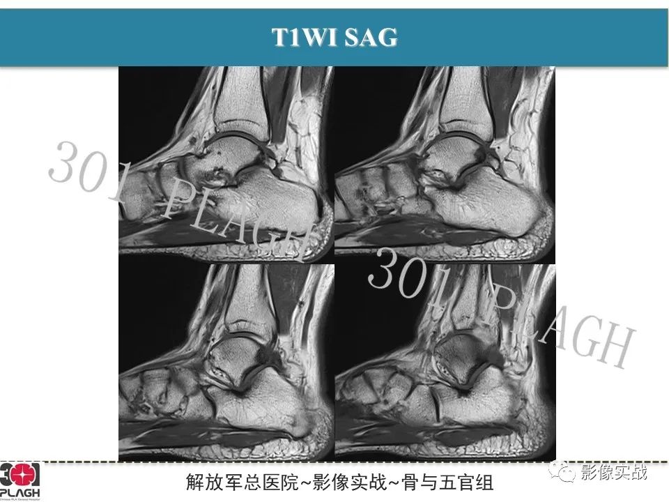 影像PPT - 【病例】后踝撞击综合征1例MR影像-3