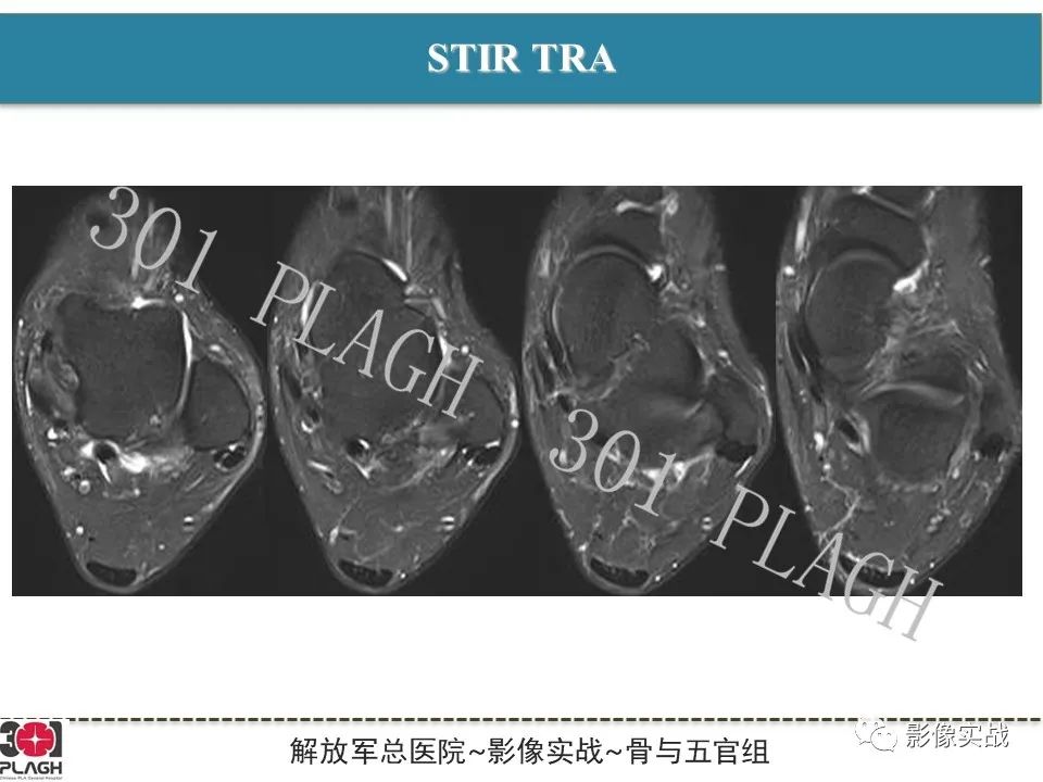 影像PPT - 【病例】后踝撞击综合征1例MR影像-5