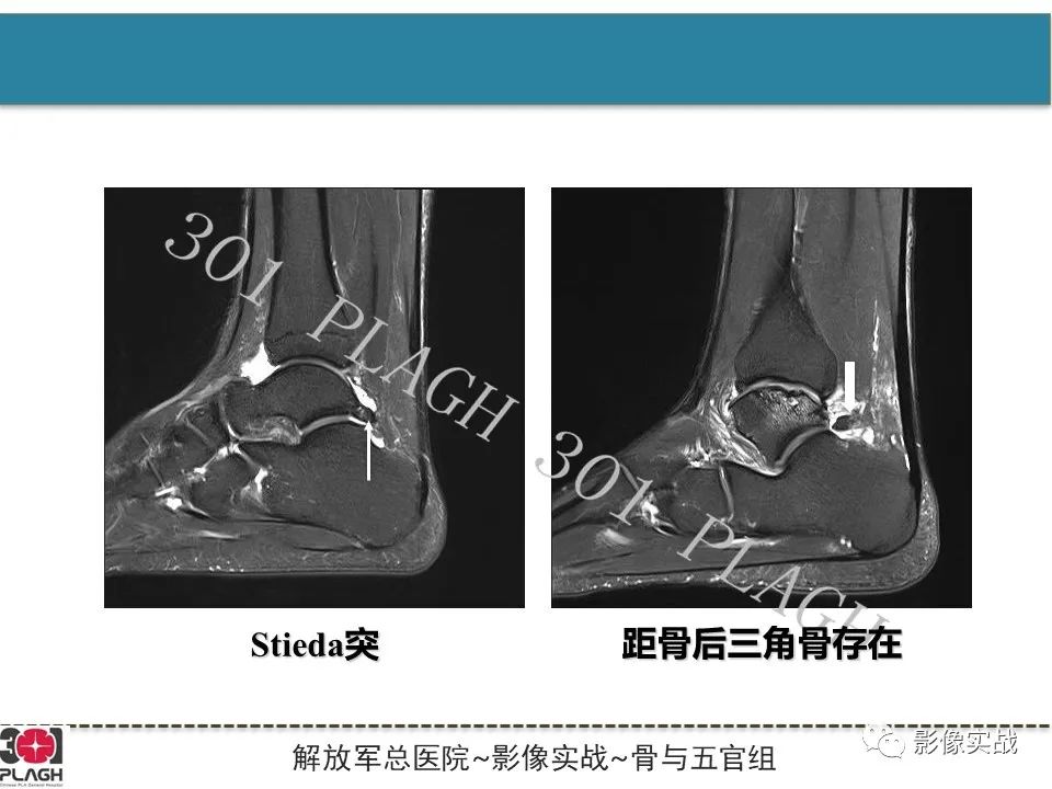 影像PPT - 【病例】后踝撞击综合征1例MR影像-9