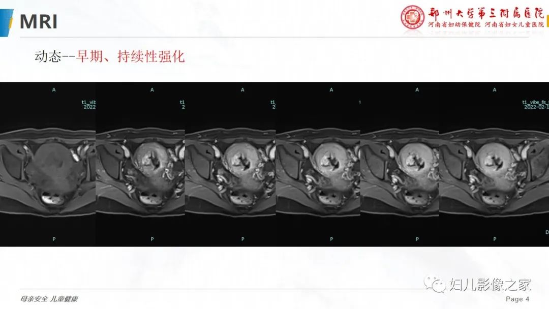 影像PPT - 【PPT】子宫内膜间质肉瘤的影像诊断-4