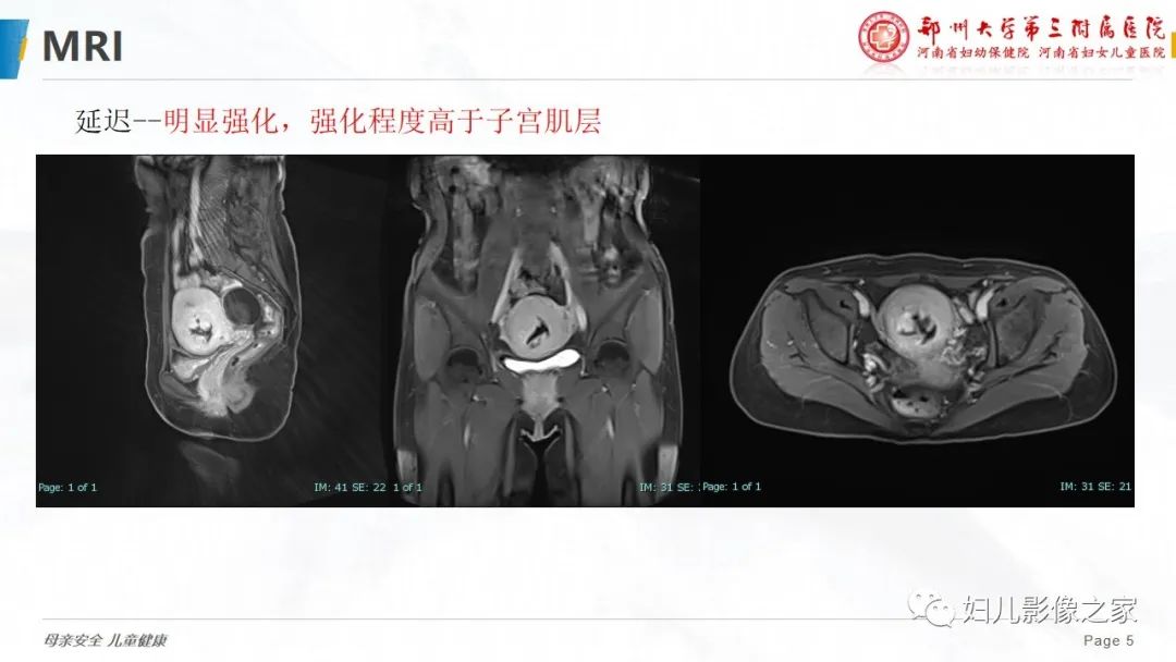 影像PPT - 【PPT】子宫内膜间质肉瘤的影像诊断-5