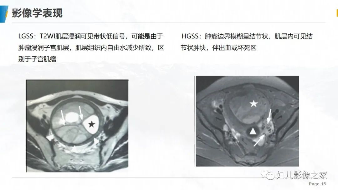 影像PPT - 【PPT】子宫内膜间质肉瘤的影像诊断-16