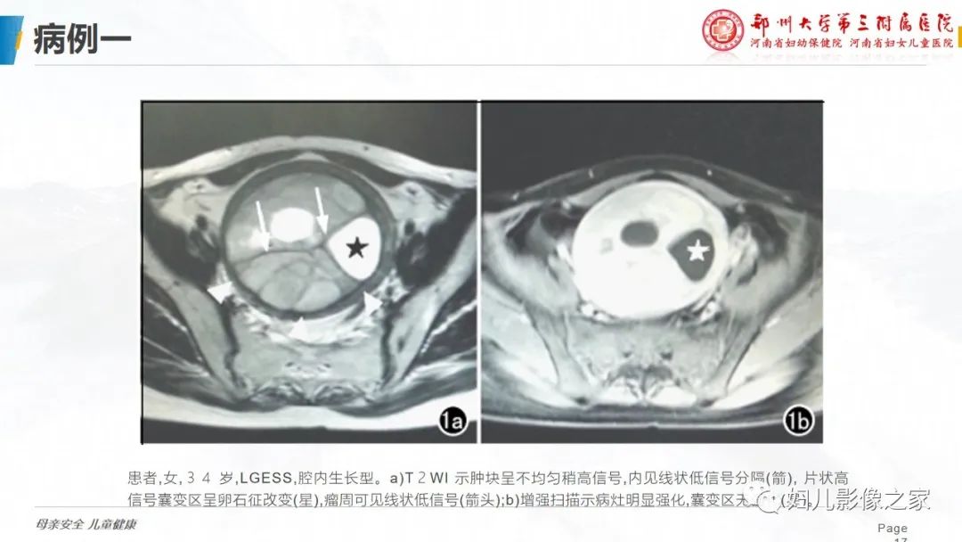 影像PPT - 【PPT】子宫内膜间质肉瘤的影像诊断-17