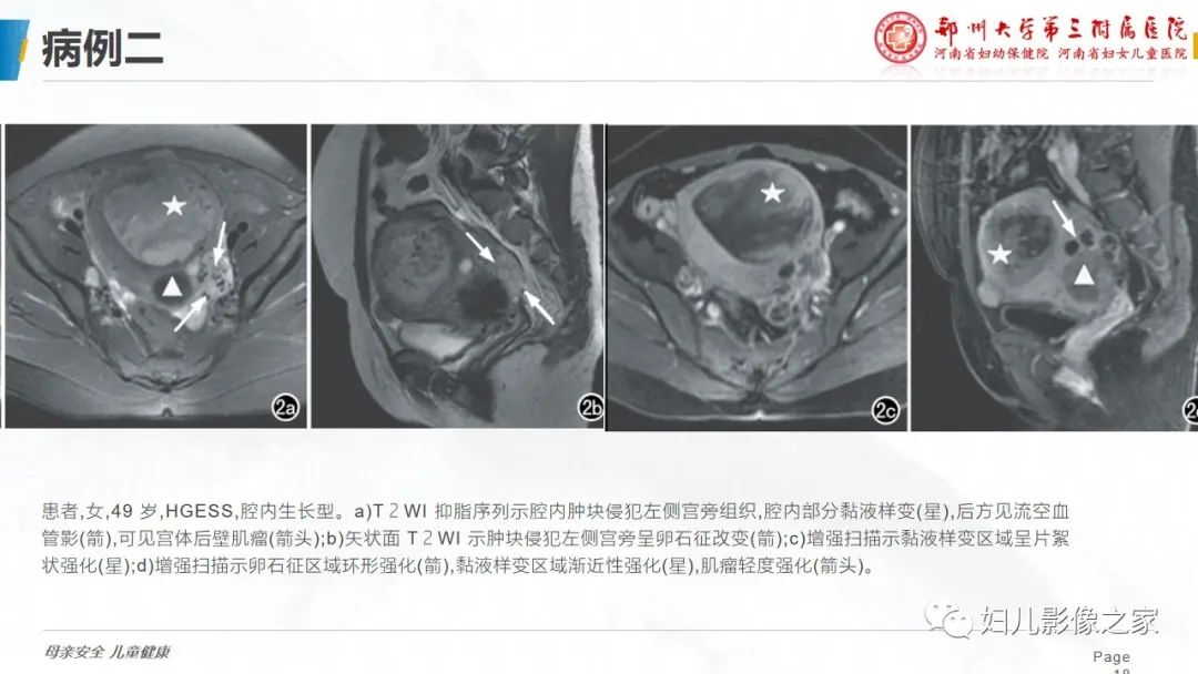 影像PPT - 【PPT】子宫内膜间质肉瘤的影像诊断-18