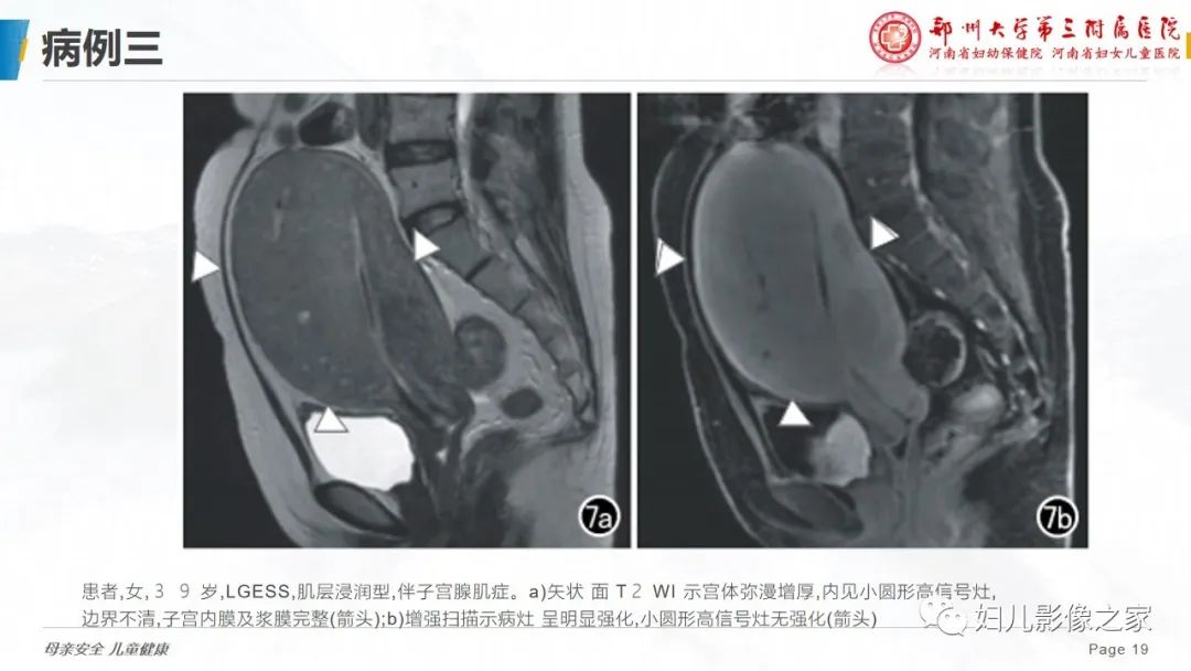 影像PPT - 【PPT】子宫内膜间质肉瘤的影像诊断-19