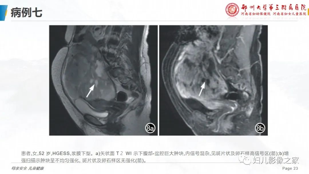 影像PPT - 【PPT】子宫内膜间质肉瘤的影像诊断-23