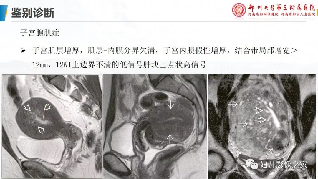 影像PPT - 【PPT】子宫内膜间质肉瘤的影像诊断-29