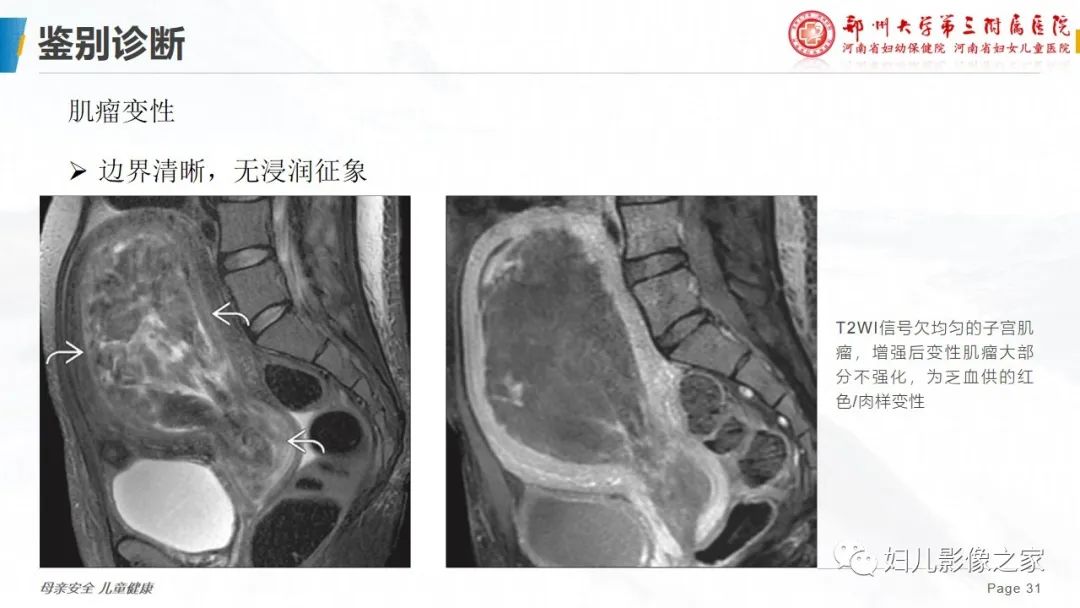 影像PPT - 【PPT】子宫内膜间质肉瘤的影像诊断-31