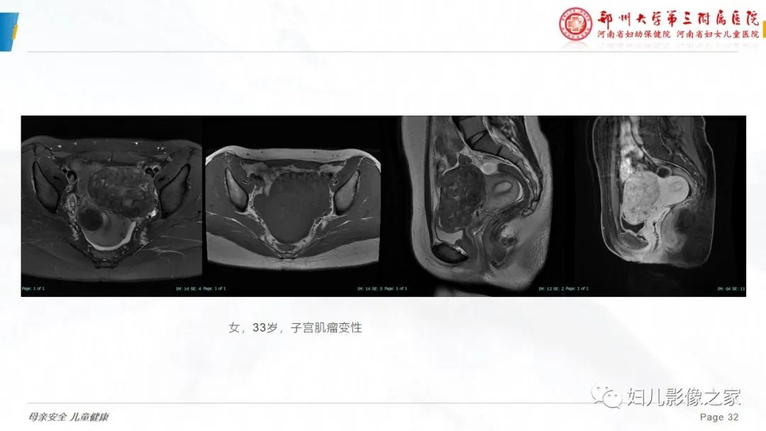影像PPT - 【PPT】子宫内膜间质肉瘤的影像诊断-32