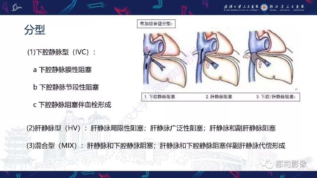 影像PPT - 【PPT】布加综合征影像学表现和鉴别诊断-6
