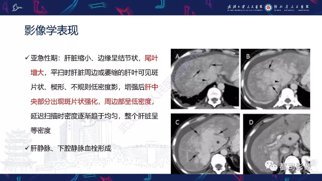 影像PPT - 【PPT】布加综合征影像学表现和鉴别诊断-10