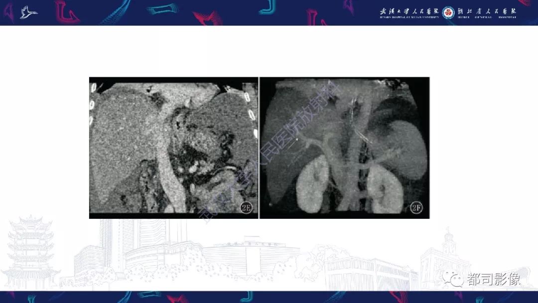影像PPT - 【PPT】布加综合征影像学表现和鉴别诊断-21