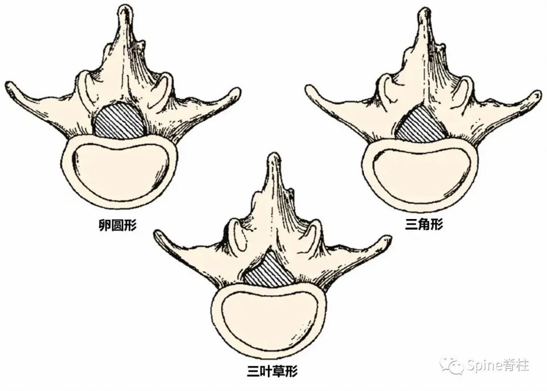影像PPT - 侧隐窝详细解剖-2 影像PPT - 侧隐窝详细解剖-2