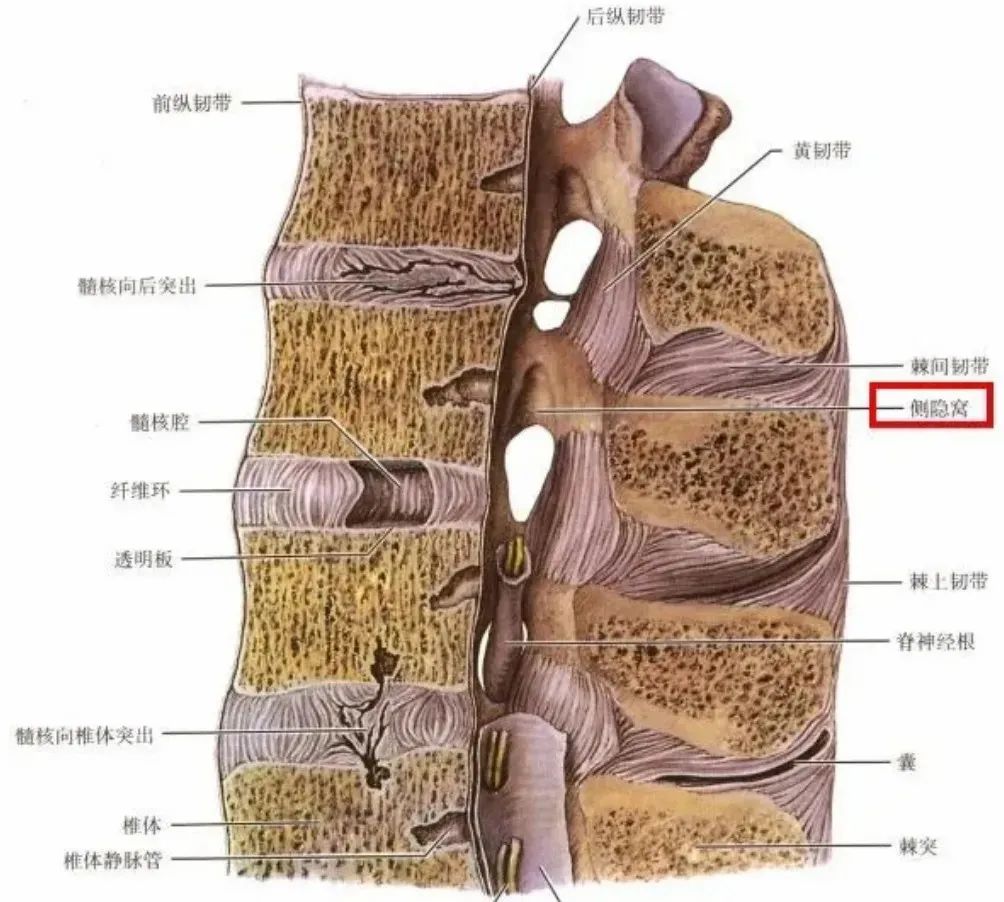 影像PPT - 侧隐窝详细解剖-3 影像PPT - 侧隐窝详细解剖-3