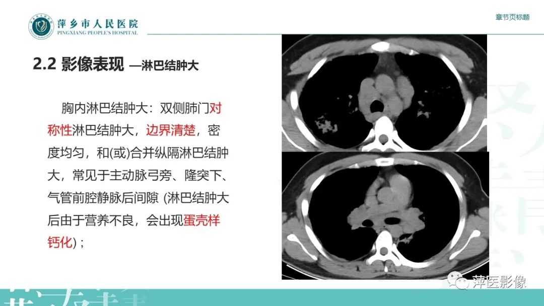 影像PPT - 【PPT】肺结节病-9