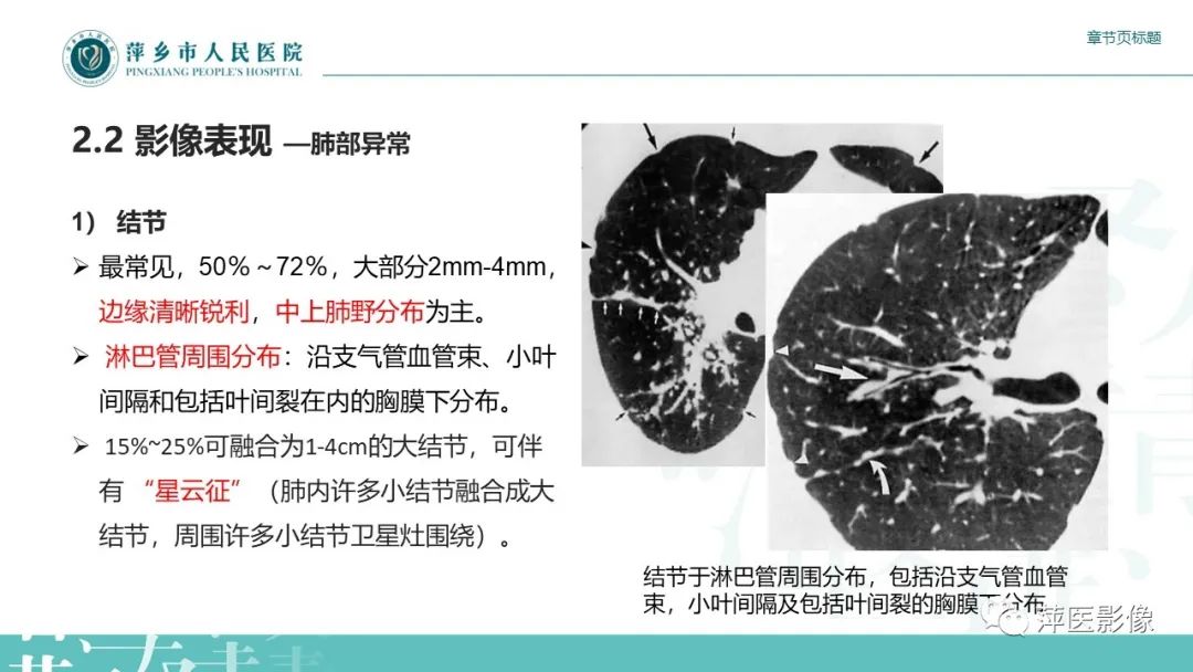影像PPT - 【PPT】肺结节病-11