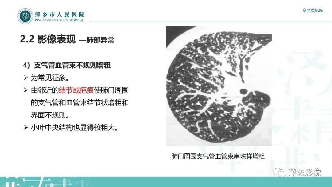 影像PPT - 【PPT】肺结节病-14
