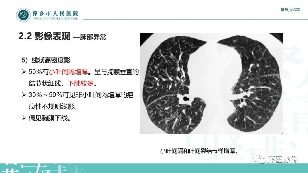 影像PPT - 【PPT】肺结节病-15