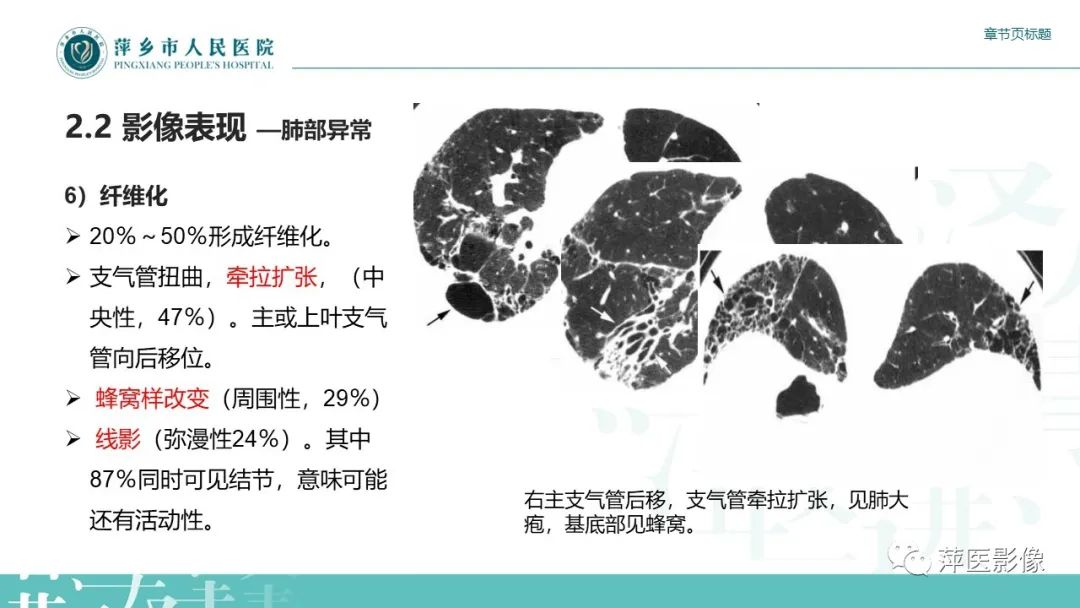 影像PPT - 【PPT】肺结节病-16