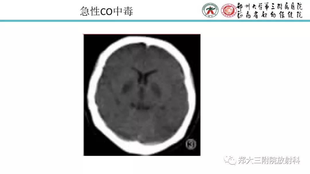 影像PPT - 【PPT】中毒性脑病影像学诊断-10