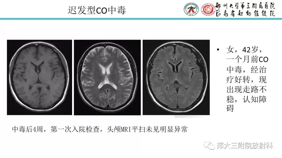 影像PPT - 【PPT】中毒性脑病影像学诊断-11