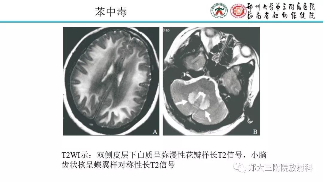 影像PPT - 【PPT】中毒性脑病影像学诊断-14