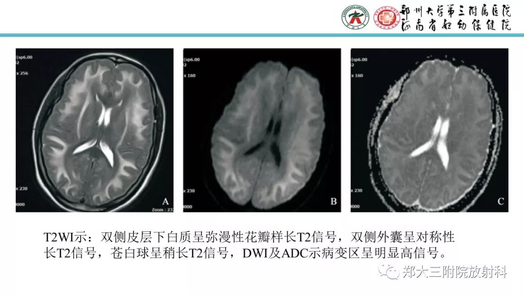 影像PPT - 【PPT】中毒性脑病影像学诊断-15