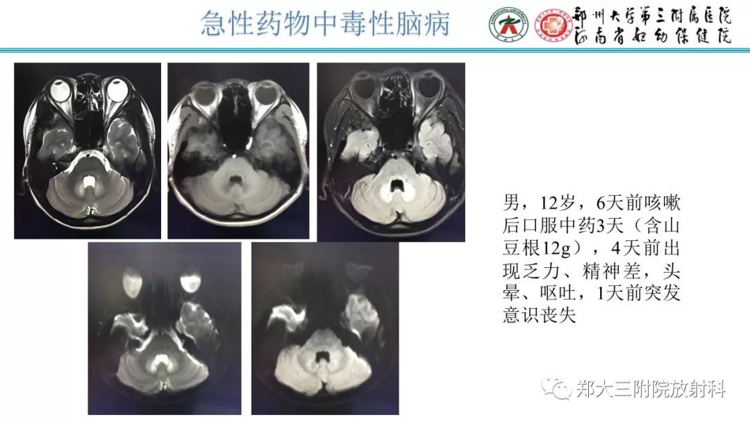 影像PPT - 【PPT】中毒性脑病影像学诊断-16
