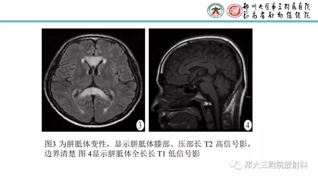 影像PPT - 【PPT】中毒性脑病影像学诊断-20