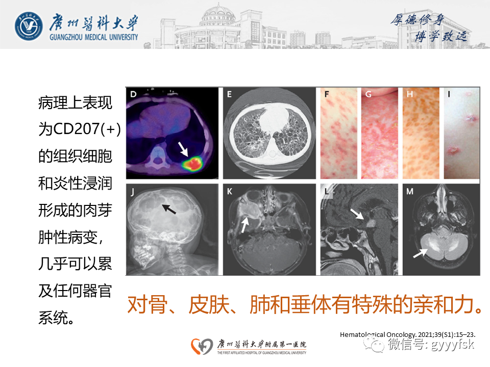 影像PPT - 【PPT】朗格汉斯细胞组织细胞增生症系统性影像表现-5