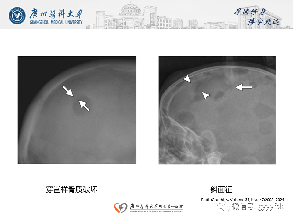 影像PPT - 【PPT】朗格汉斯细胞组织细胞增生症系统性影像表现-10