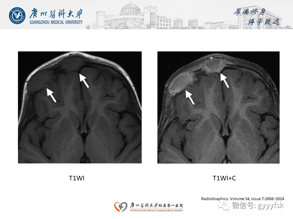 影像PPT - 【PPT】朗格汉斯细胞组织细胞增生症系统性影像表现-11