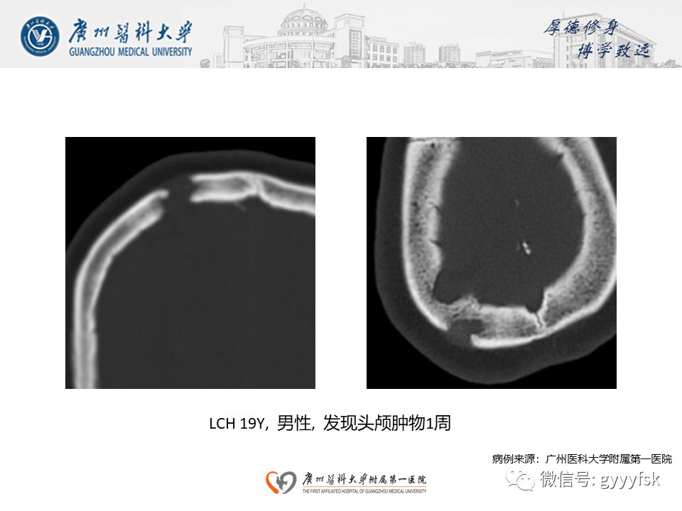 影像PPT - 【PPT】朗格汉斯细胞组织细胞增生症系统性影像表现-12