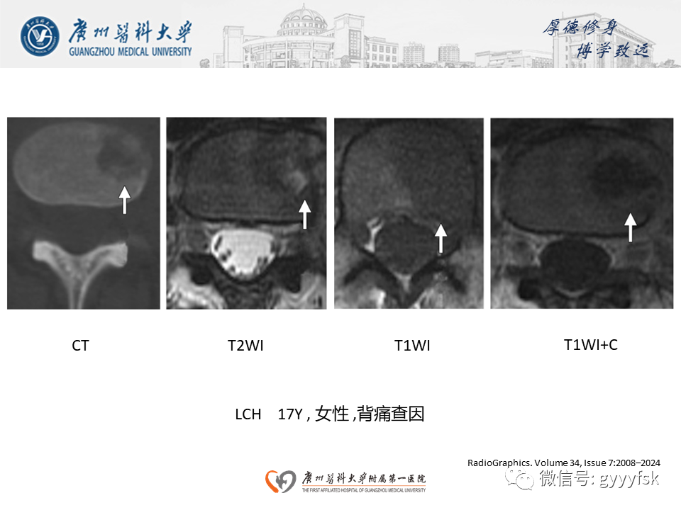 影像PPT - 【PPT】朗格汉斯细胞组织细胞增生症系统性影像表现-14