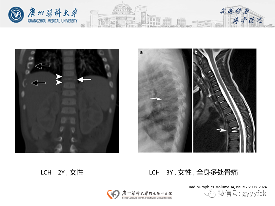 影像PPT - 【PPT】朗格汉斯细胞组织细胞增生症系统性影像表现-15