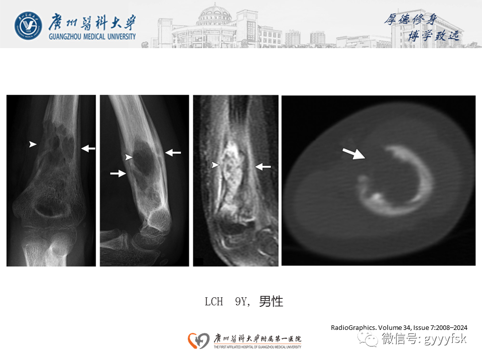 影像PPT - 【PPT】朗格汉斯细胞组织细胞增生症系统性影像表现-17