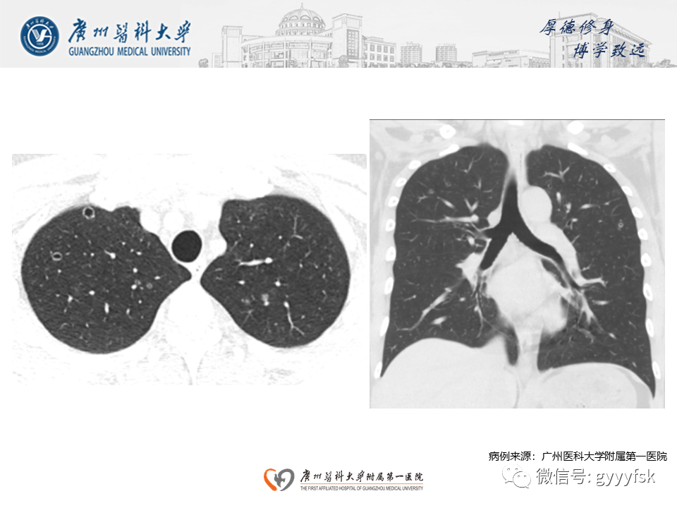 影像PPT - 【PPT】朗格汉斯细胞组织细胞增生症系统性影像表现-20