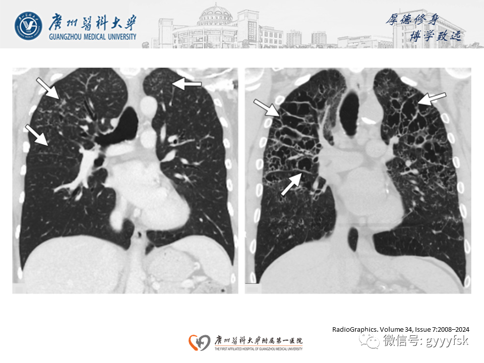 影像PPT - 【PPT】朗格汉斯细胞组织细胞增生症系统性影像表现-21