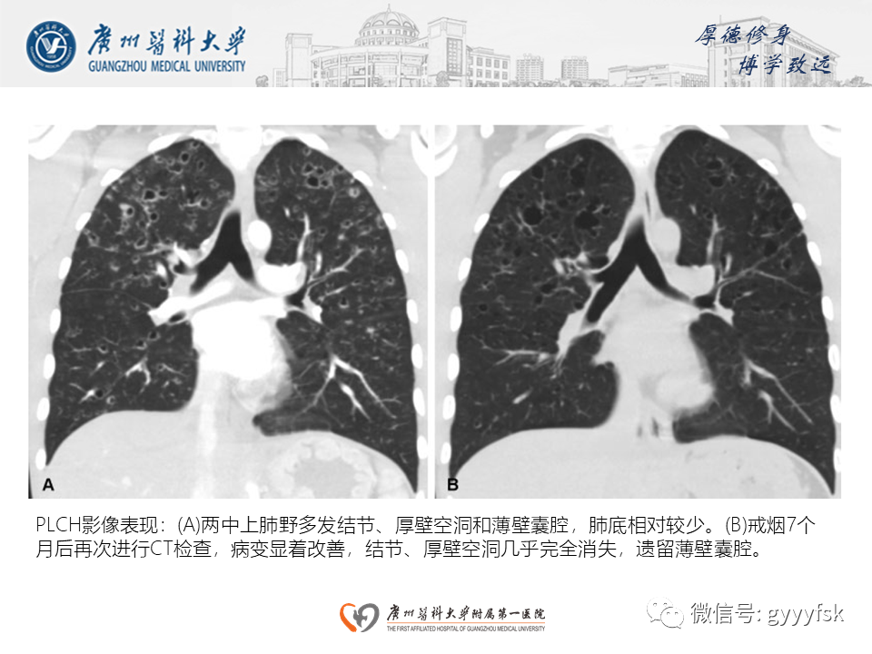影像PPT - 【PPT】朗格汉斯细胞组织细胞增生症系统性影像表现-22