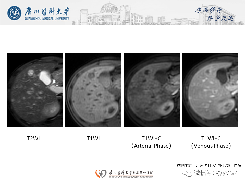 影像PPT - 【PPT】朗格汉斯细胞组织细胞增生症系统性影像表现-29