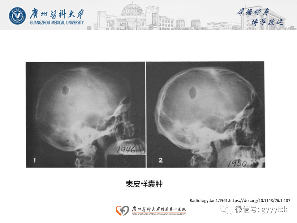 影像PPT - 【PPT】朗格汉斯细胞组织细胞增生症系统性影像表现-31
