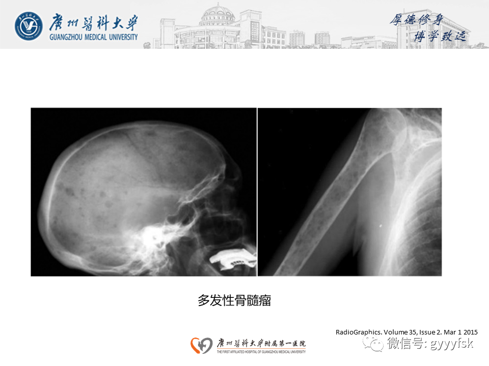 影像PPT - 【PPT】朗格汉斯细胞组织细胞增生症系统性影像表现-32