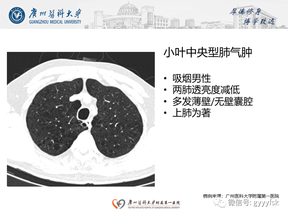 影像PPT - 【PPT】朗格汉斯细胞组织细胞增生症系统性影像表现-34