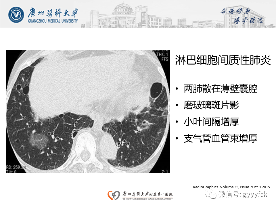 影像PPT - 【PPT】朗格汉斯细胞组织细胞增生症系统性影像表现-36