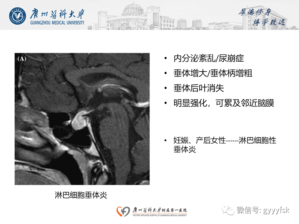 影像PPT - 【PPT】朗格汉斯细胞组织细胞增生症系统性影像表现-38