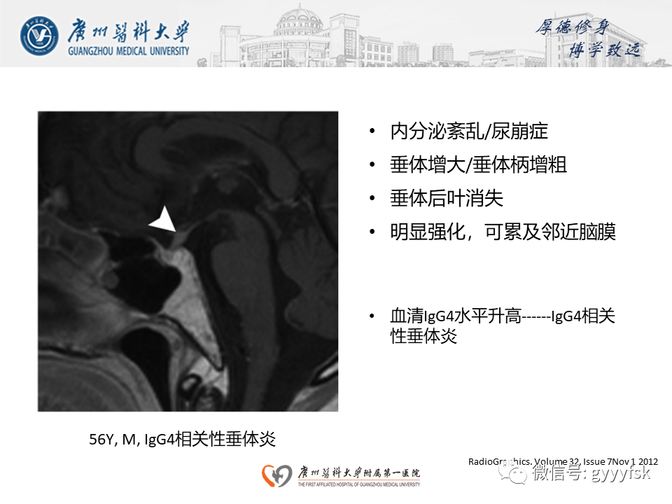 影像PPT - 【PPT】朗格汉斯细胞组织细胞增生症系统性影像表现-39